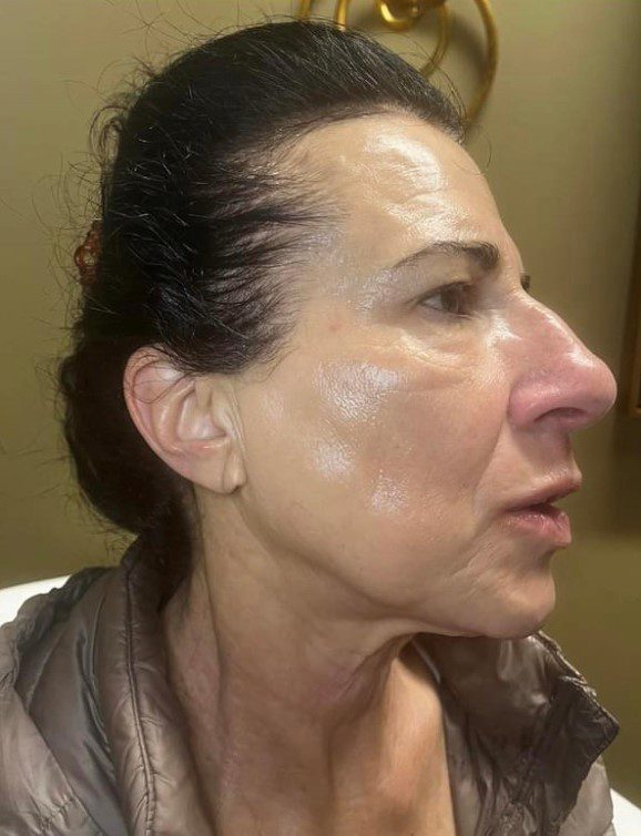 After microneedling profile treatment