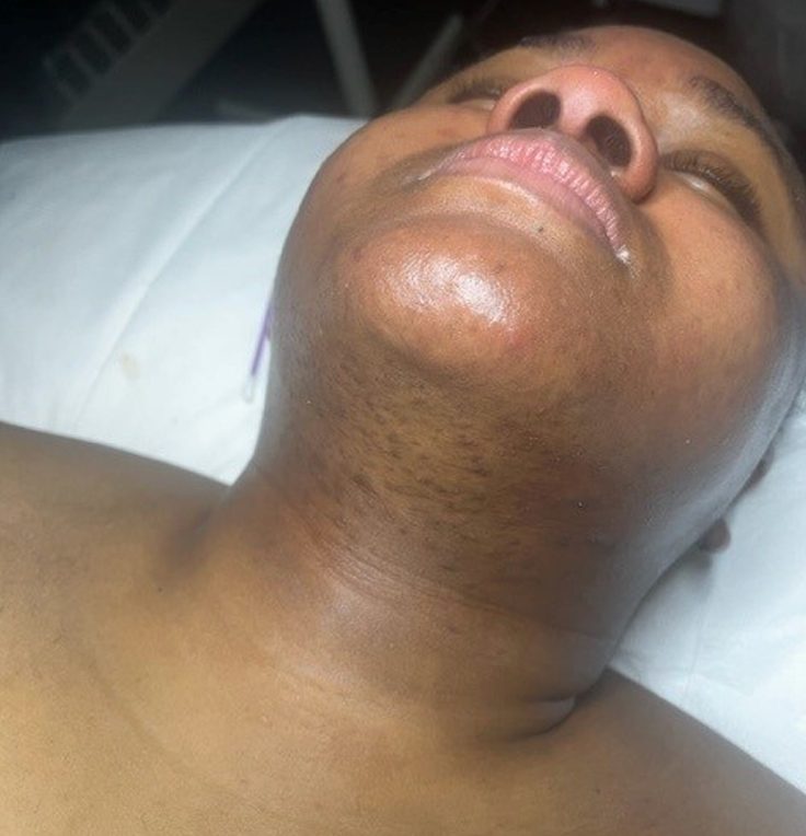 After microneedling neck and chin treatment