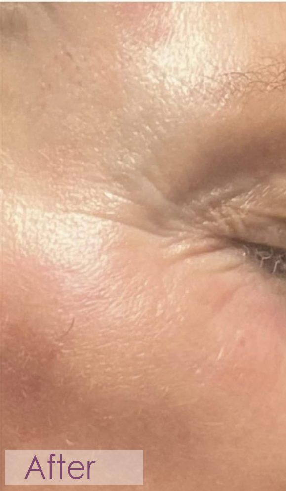 After RF microneedling eye area treatment
