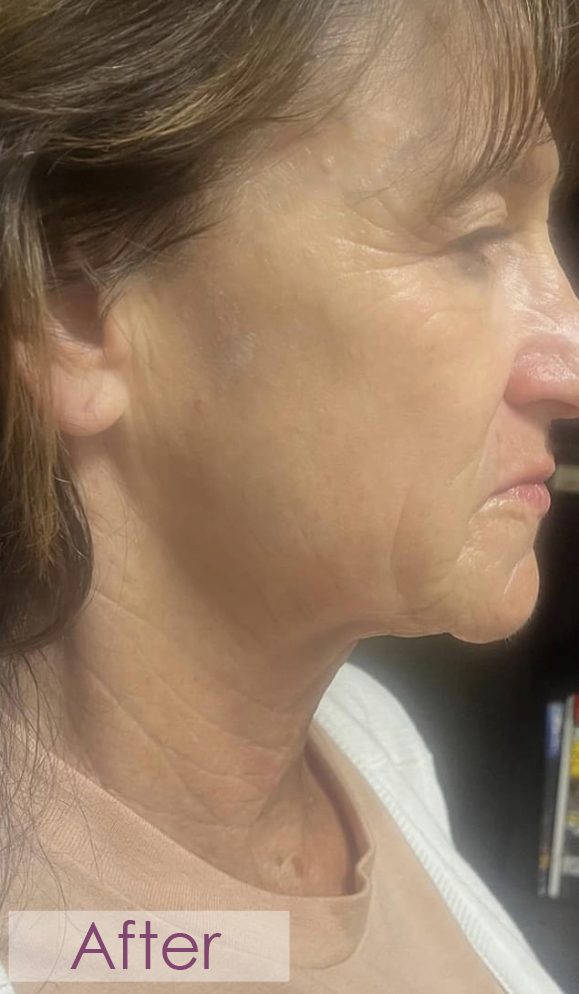 After RF microneedling jawline treatment