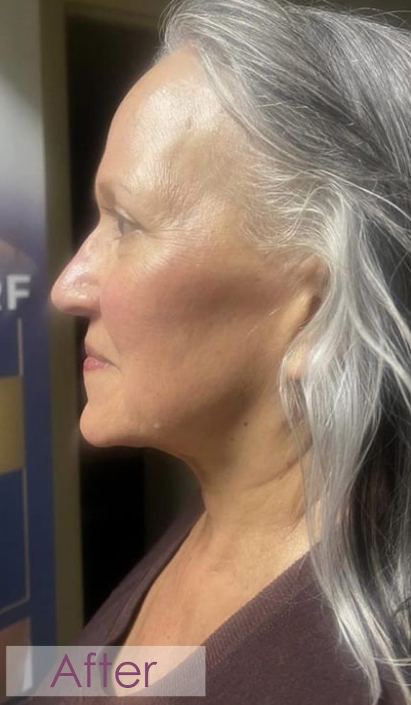 After RF microneedling profile treatment