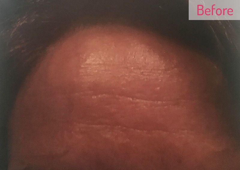 Before microneedling forehead treatment