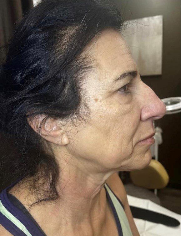 Before microneedling profile treatment