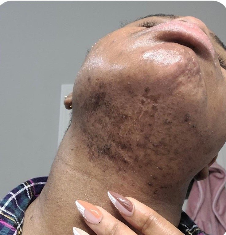 Before microneedling neck and chin treatment