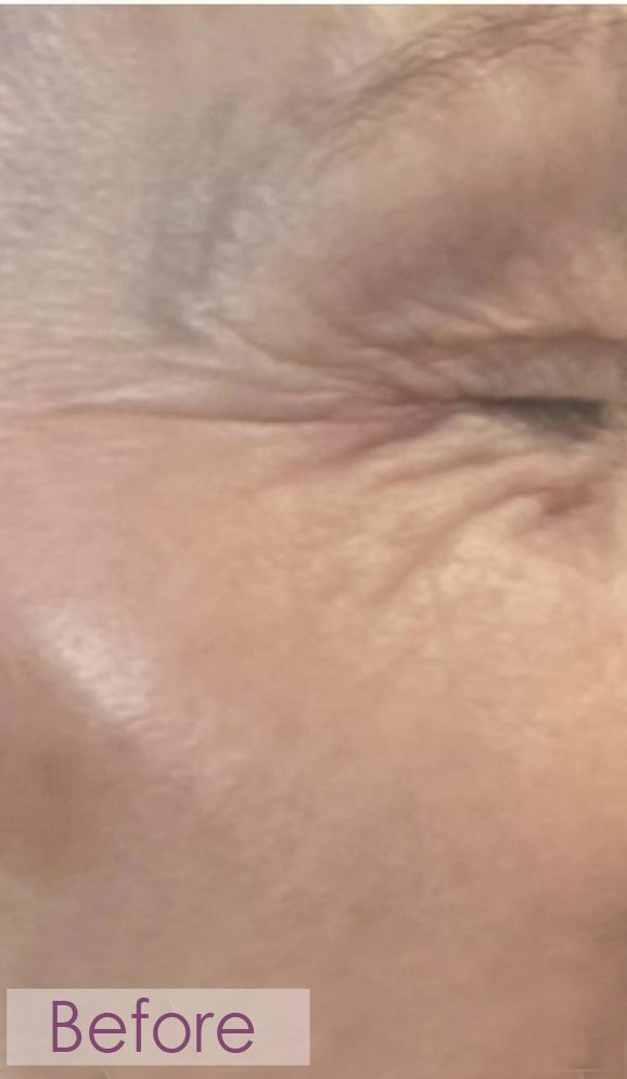 Before RF microneedling eye area treatment