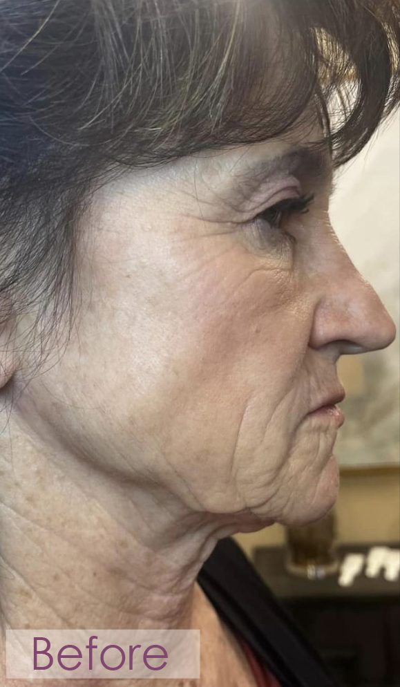 Before RF microneedling jawline treatment