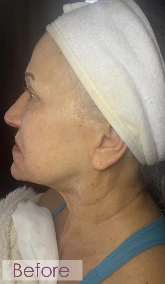 Before RF microneedling profile treatment